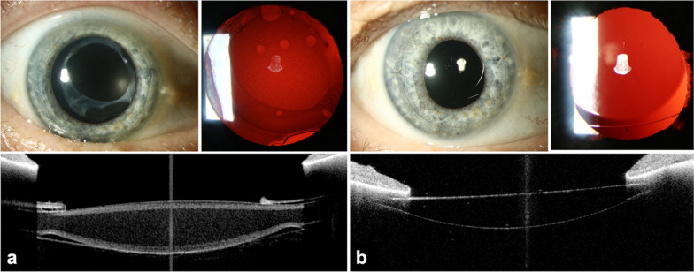 Next article: An objective decision criterion for IOL exchange