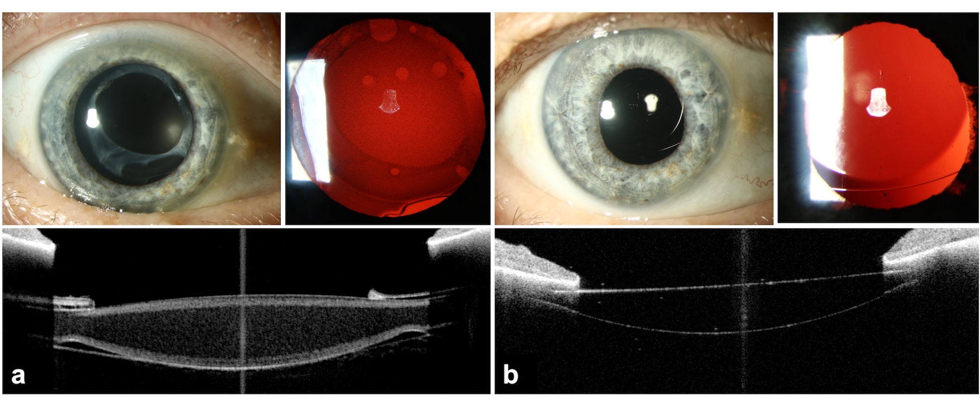 Previous article: Safety in IOL exchange