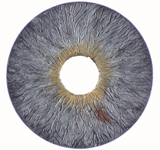 (This image of the AI Silicone Artificial Iris prosthesis was provided by HumanOptics AG, Erlangen, Germany. ) /assets/images/ai-figure