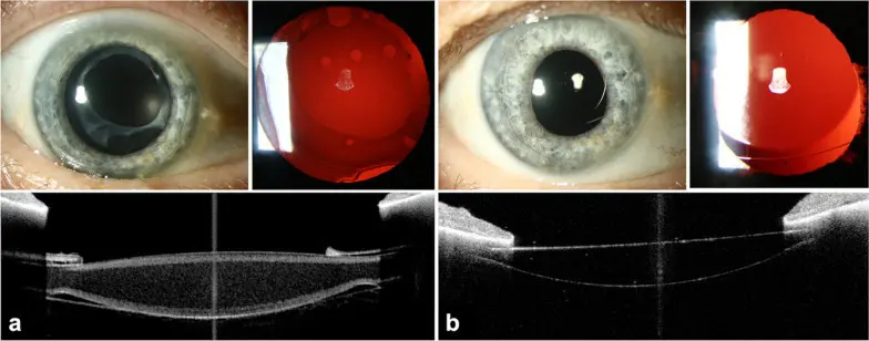 An objective decision criterion for IOL exchange - Featured image