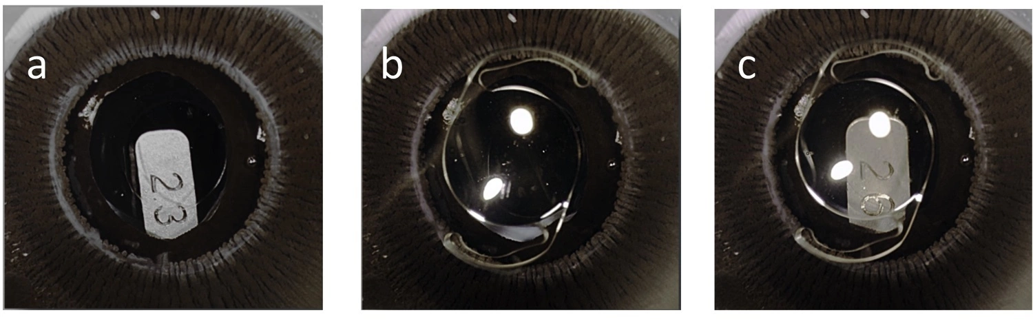 Comparing preloaded IOL-injector systems - Featured image