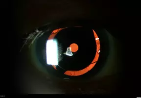 Pinhole Xtrafocus - Article thumbnail