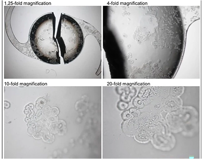 Gross microscopy of the explanted IOL