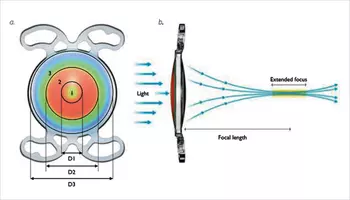 Functional results and photic phenomena with Mini WELL Ready IOL - Article thumbnail