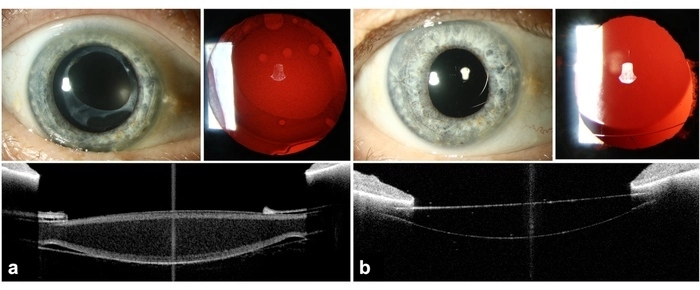 a. before IOL exchange and b after IOL exchange