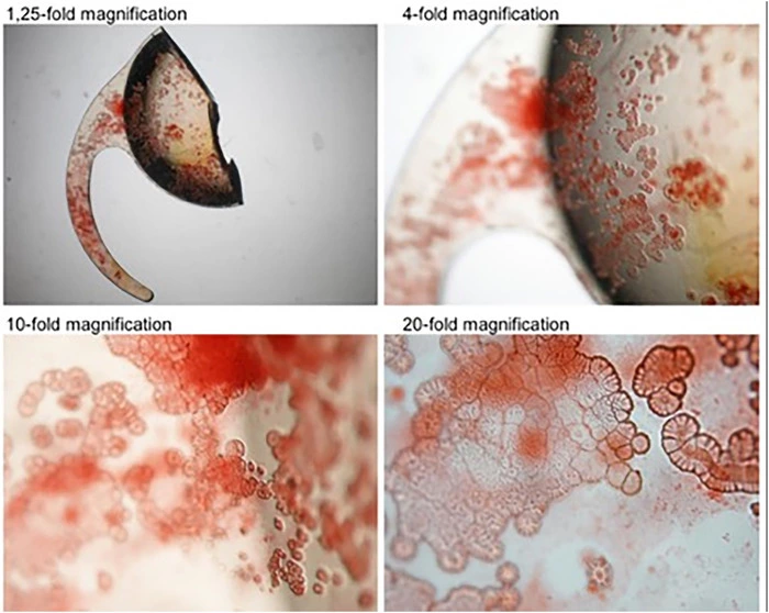 The IOL stained with Alizarin Red
